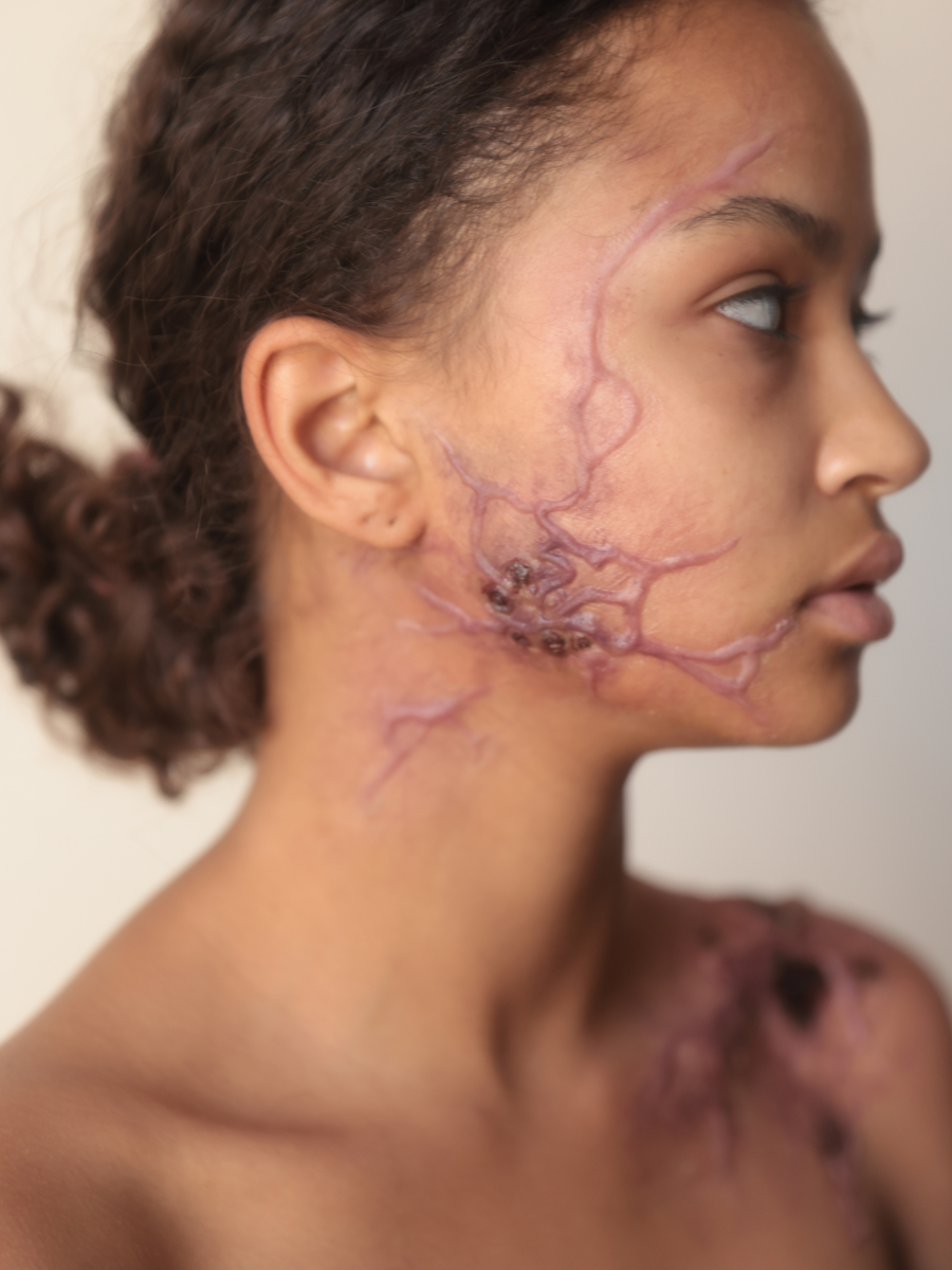 Veines infectées - Set de 2 prohèses