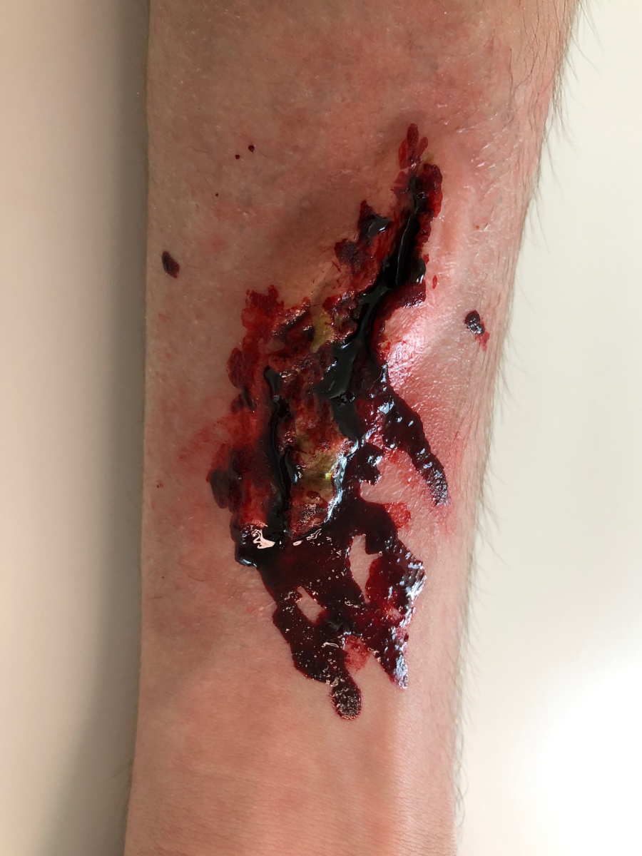 Plaie infectée #1